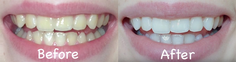 Crest 3d white strips before and after